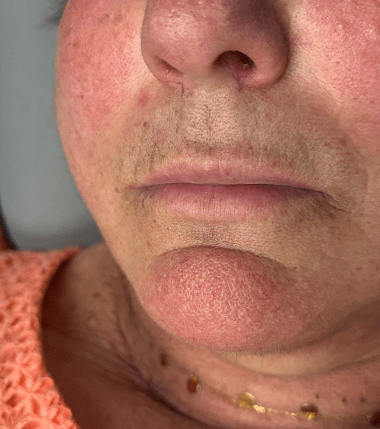 Skin Refinement before