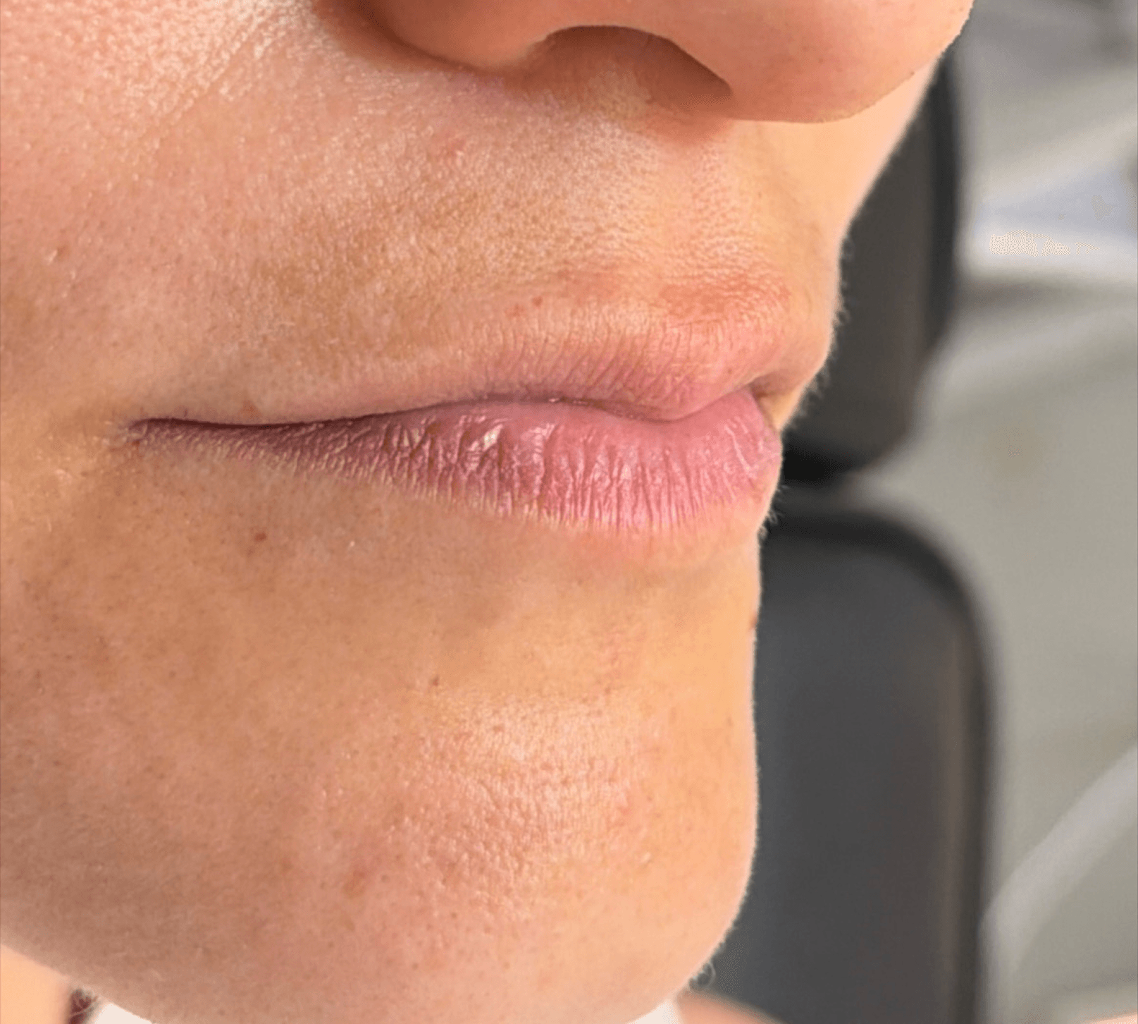 Facial Contour before