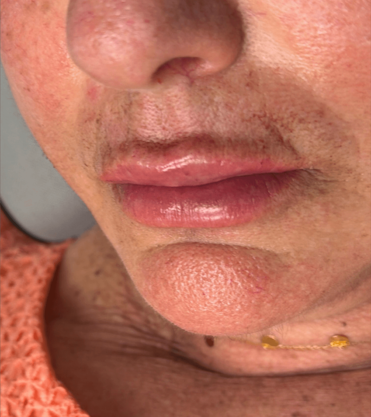 Skin Refinement after