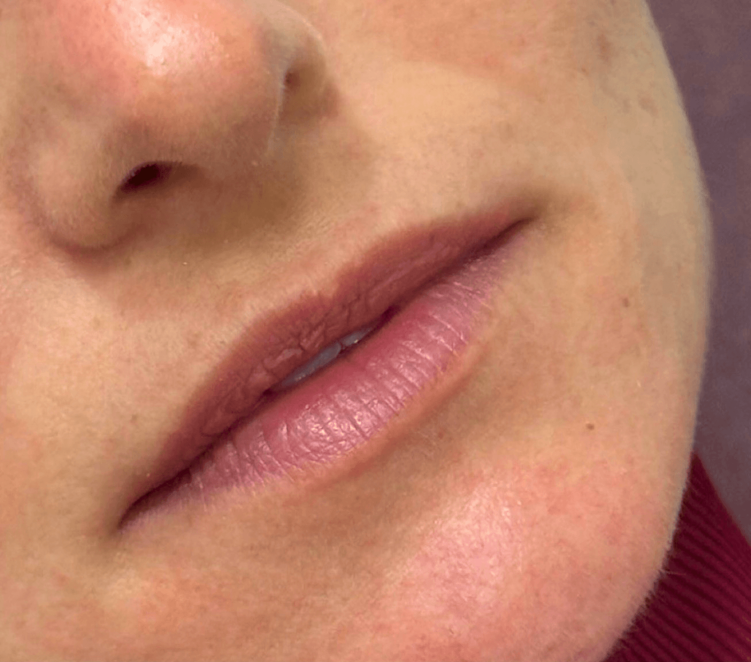Lip Treatment before
