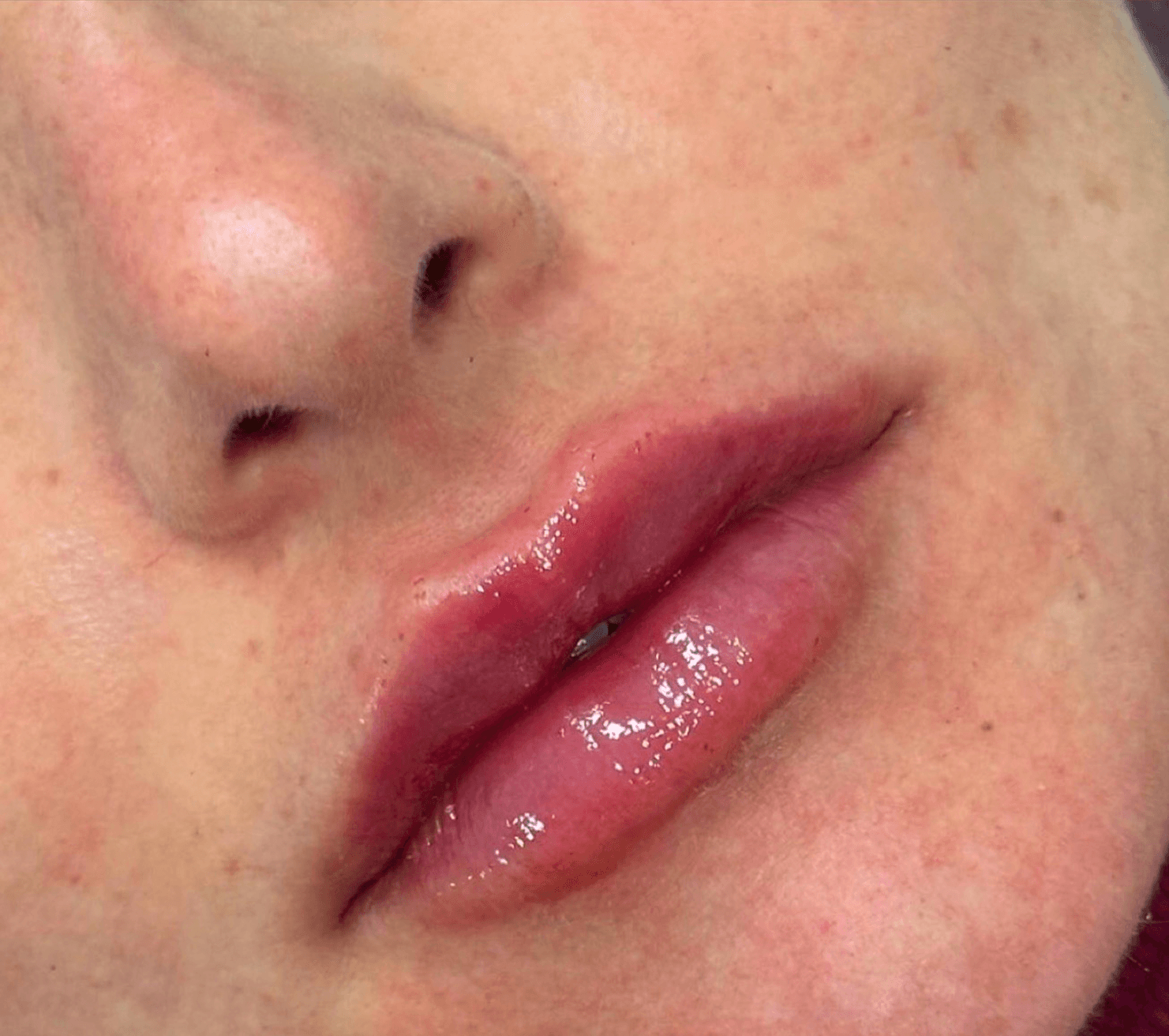 Lip Treatment after