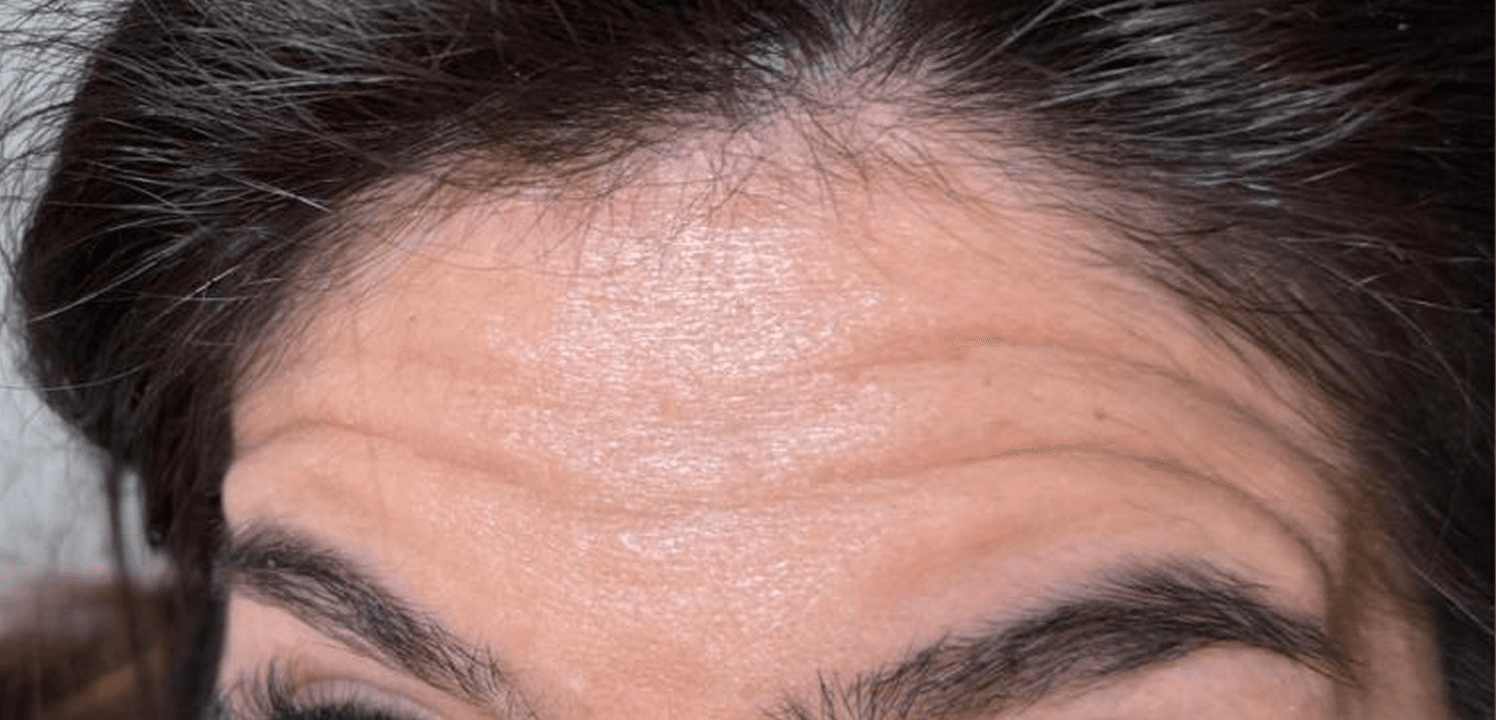 Forehead Softening before