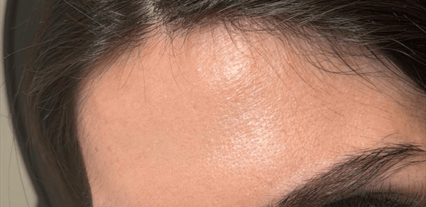 Forehead Softening after